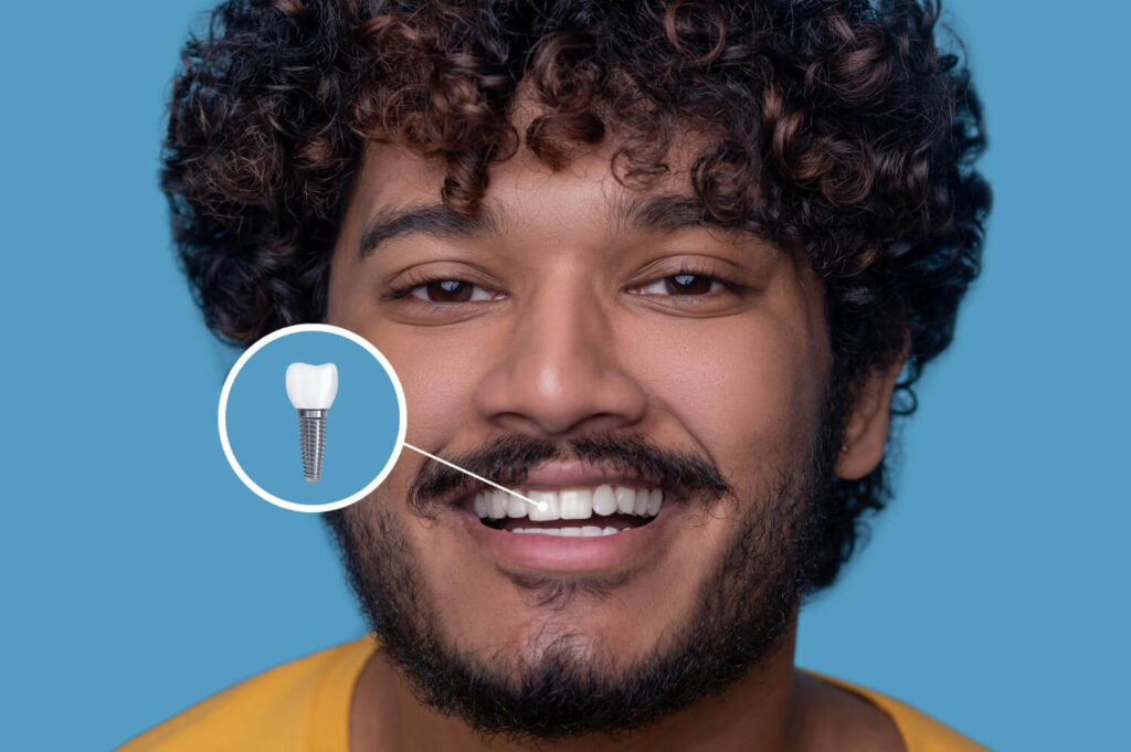 Homem sorridente com cabelos cacheados em fundo azul. Destaque gráfico para implantes dentários em Barreiras na Nakamura Odontologia. (136 caracteres)